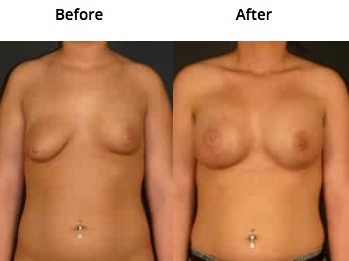 uneven breasts breast augmentation